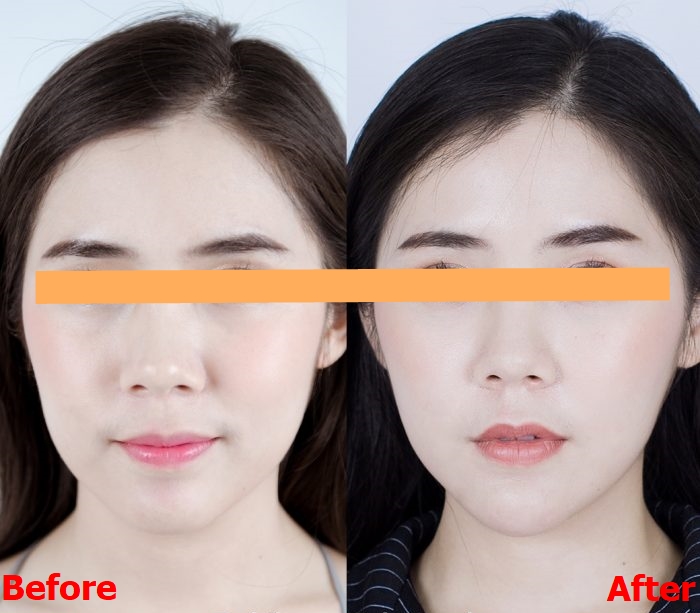 BABILONE (NEW PACKAGING) FAT BOMB FIRM AND SMOOTH SERUM REDUCE FAT FACE INJECTION by "www.ccthaitown.com"